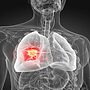 MHRA OKs First Anti-PD-1 Drug for Aggressive Lung Cancer