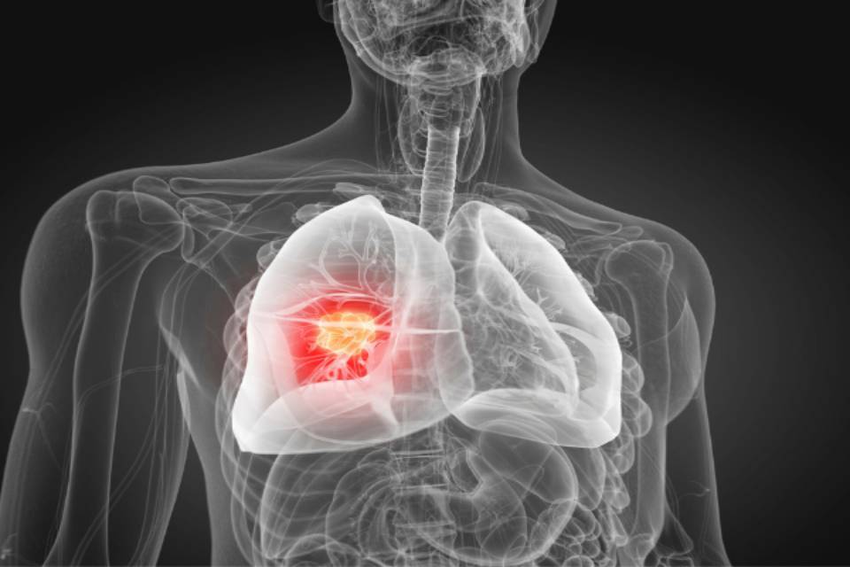 MHRA OKs First Anti-PD-1 Drug for Aggressive Lung Cancer