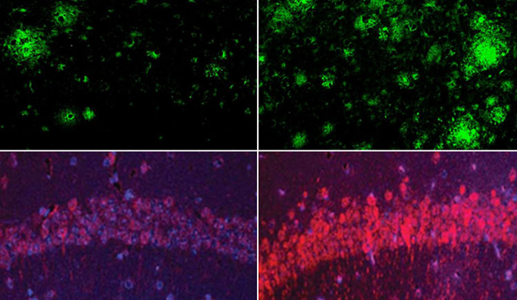 Lithium Loss Triggers Alzheimer's, Compound Reverses It