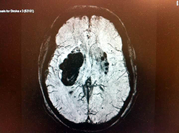 Wide Bay Welcomes Boost For Survivors Of Stroke